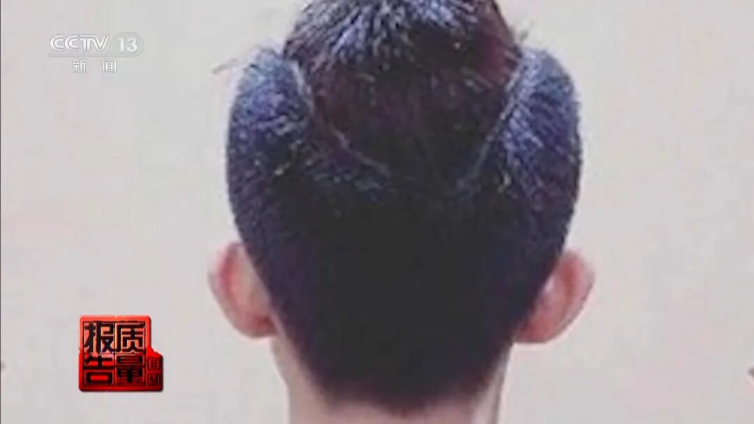 “麻药一过，生不如死”，央视曝光“精灵耳”整形乱象！一女子注射后完全面瘫，错过最佳抢救时间，神经功能恢复渺茫 (http://www.photoreceiver.com/) 财经 第8张