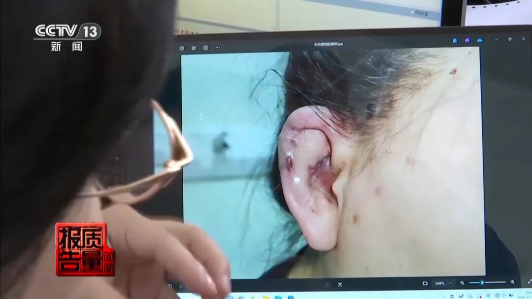 “麻药一过，生不如死”，央视曝光“精灵耳”整形乱象！一女子注射后完全面瘫，错过最佳抢救时间，神经功能恢复渺茫 (http://www.photoreceiver.com/) 财经 第6张